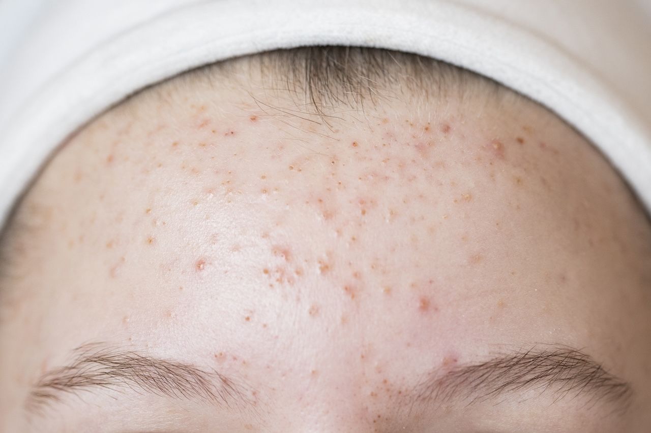 non inflamed acne including closed comedones
