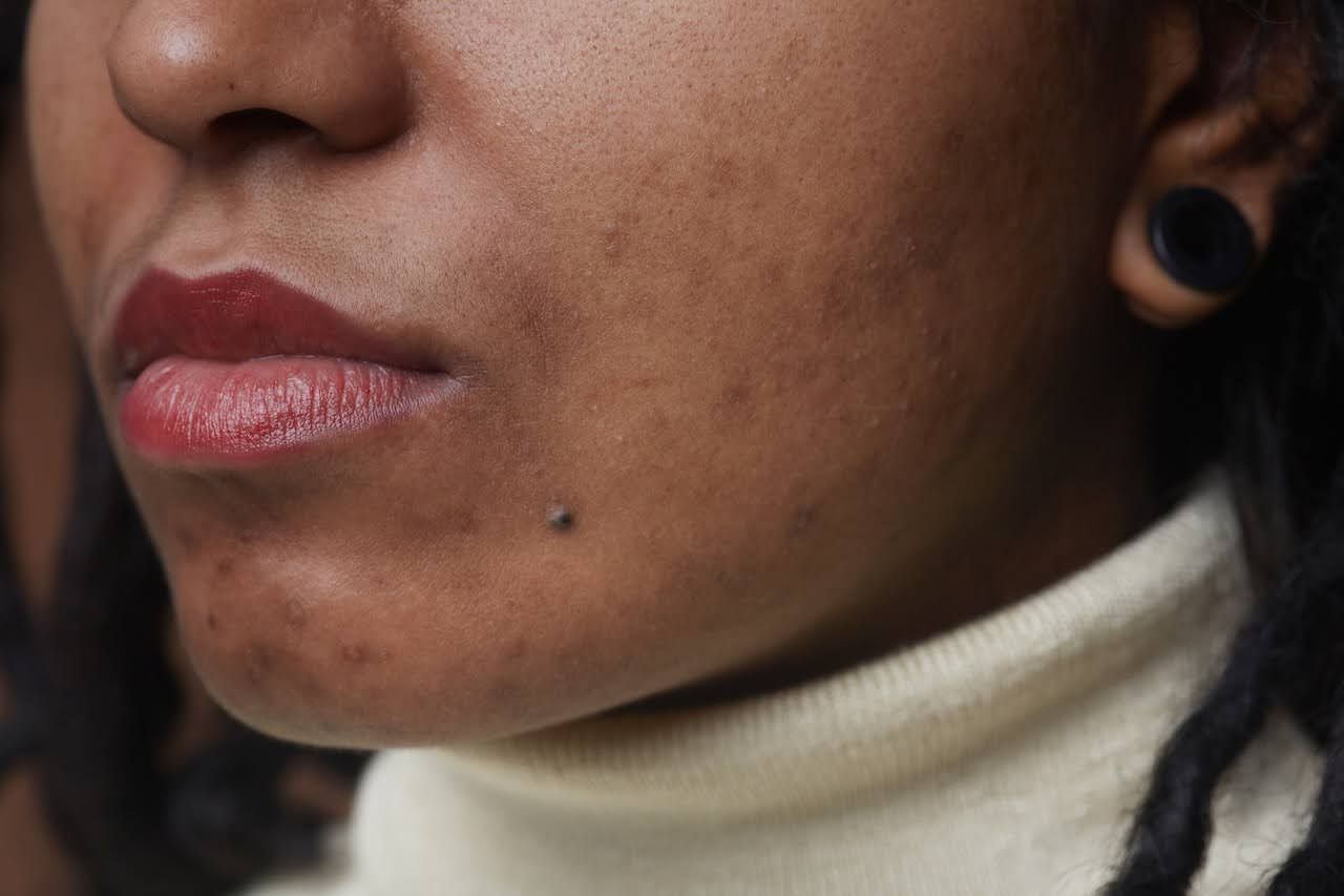 Close up of woman with acne scars
