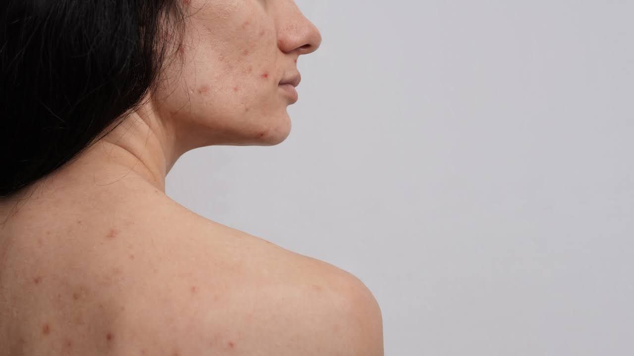 Close up of woman with adult acne