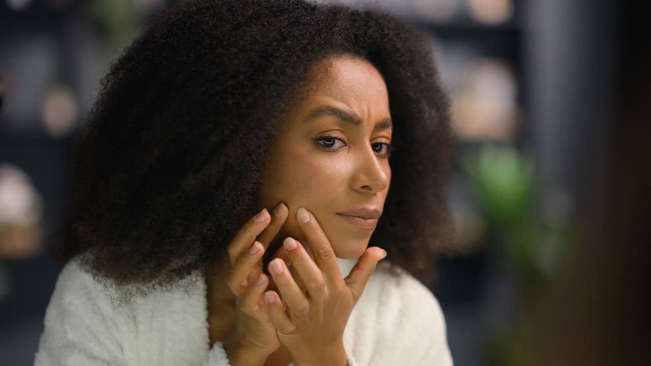 infographic for EFFECTIVE SOLUTIONS FOR ADULT ACNE IN CLIENTS 30 AND OLDER