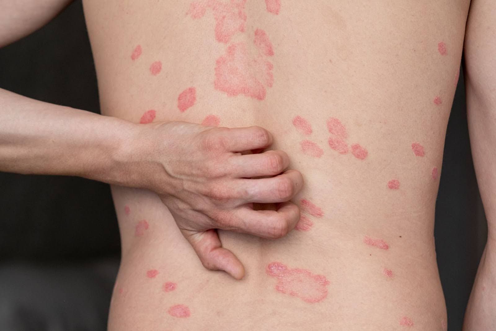 infographic for PSORIASIS TRIGGERS: WHAT YOU SHOULD KNOW