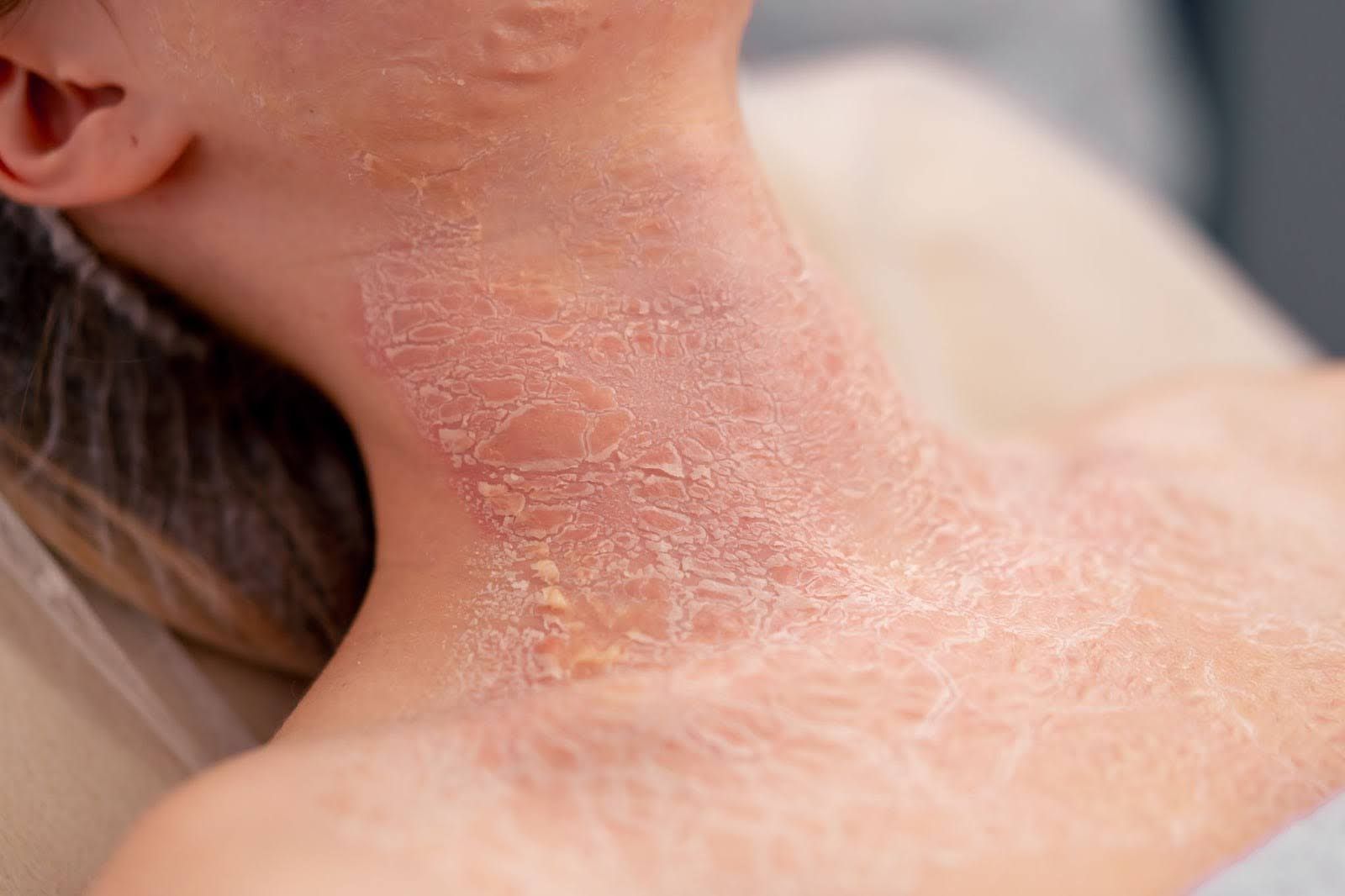 Psoriasis breakout on woman’s neck and chest