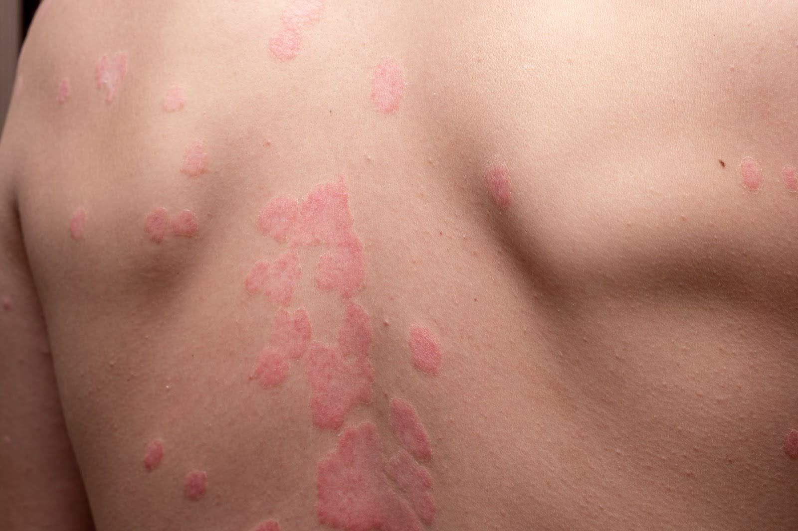 Psoriasis flareup on a person’s back