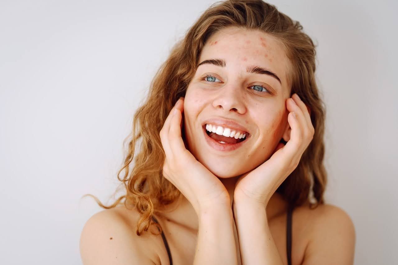 Teen taking care of acne scars