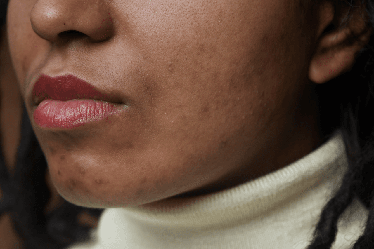 Woman after using microneedling to improve acne scars