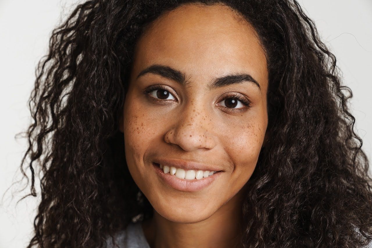 Woman with a form of hyperpigmentation