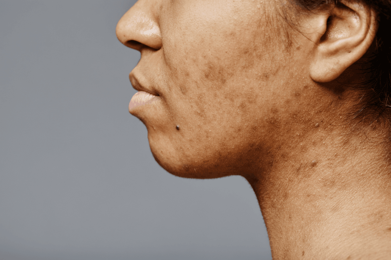 Woman with acne scarring
