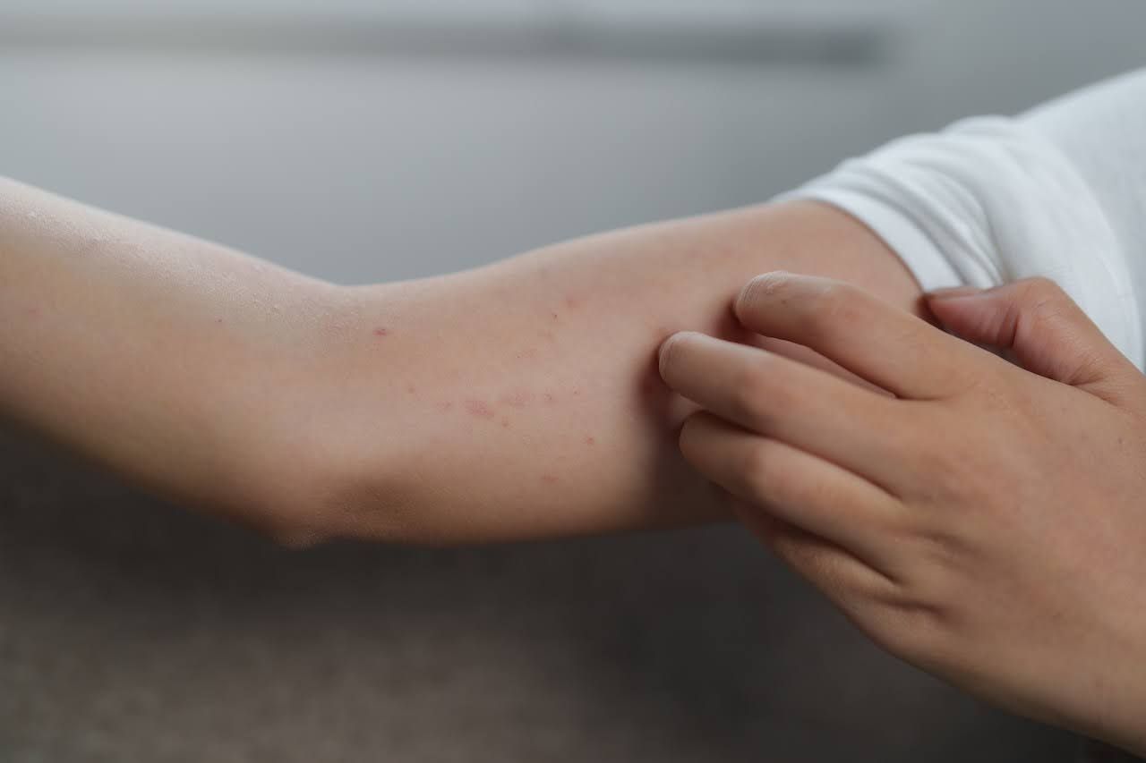 Woman with improved eczema after using skincare for eczema