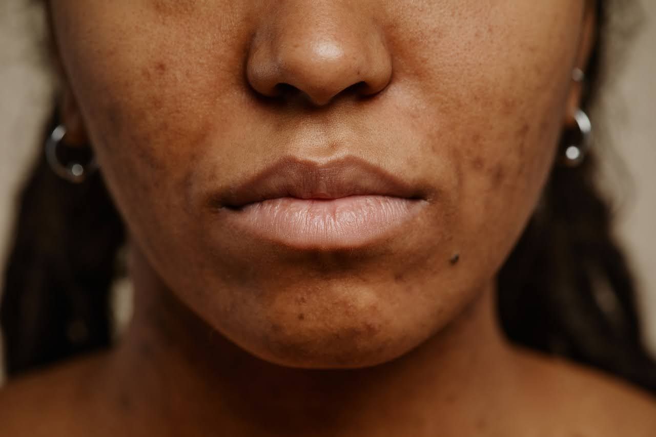 Woman with pigmentation and scarring from acne