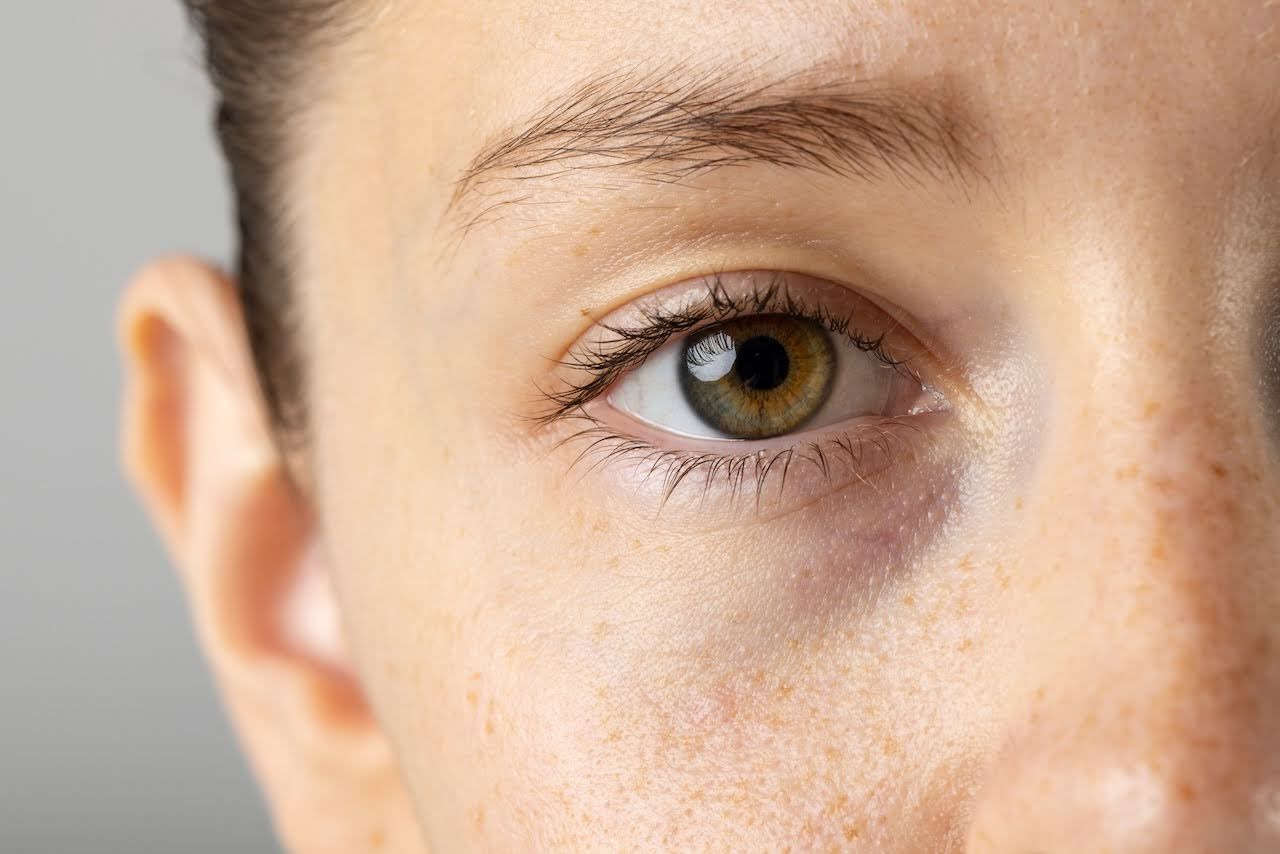 Woman with vascular dark circles.jpg