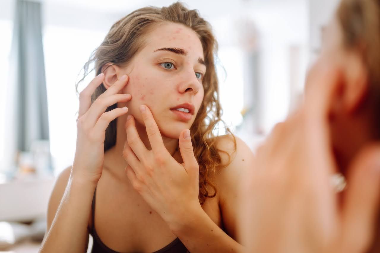 Young woman looking at menstrual acne in the mirror