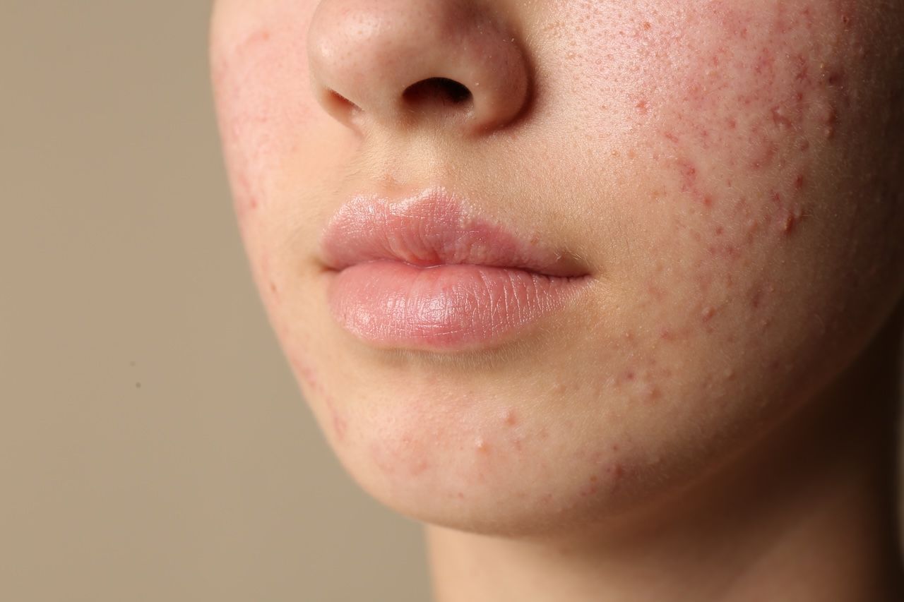 Close-up of inflammatory breakouts across the cheek and around the mouth area