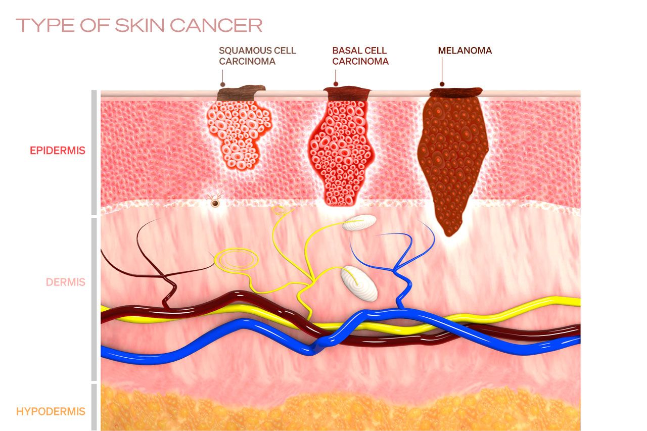 early-warning-cancer-illust