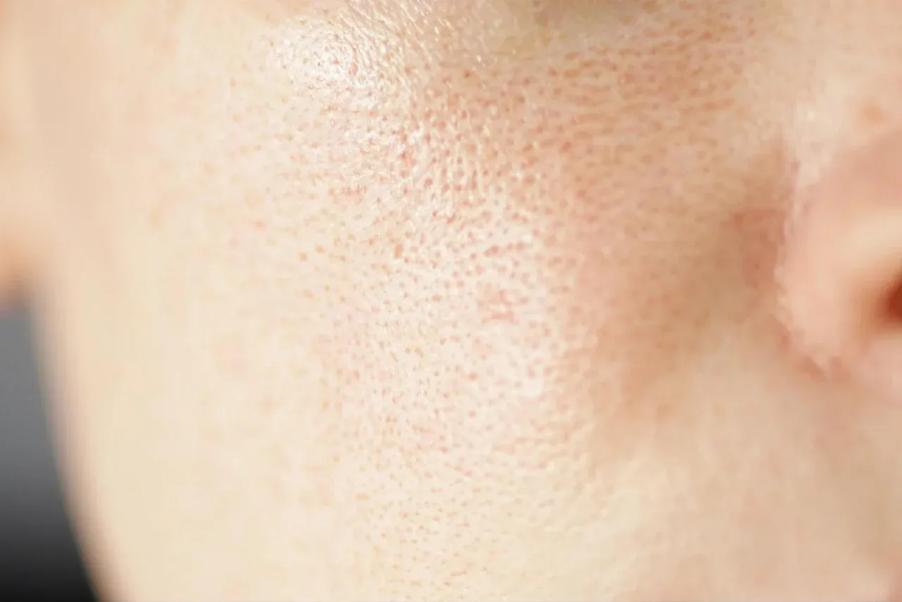 WHY ARE MY PORES SO BIG AND WHAT ACTUALLY HELPS?