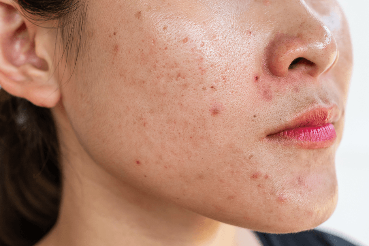 EVERYTHING YOU NEED TO KNOW ABOUT INFLAMMATORY ACNE