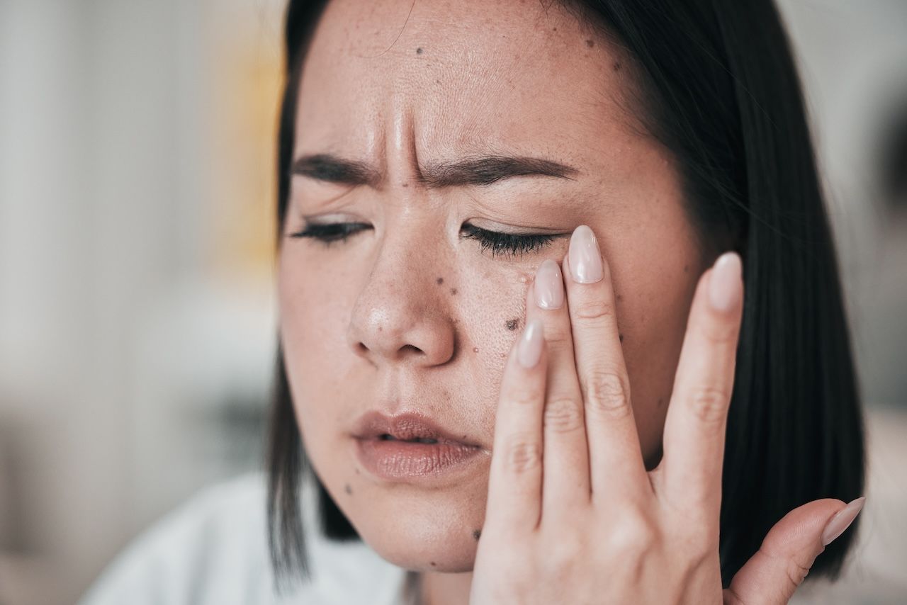 NODULAR ACNE EXPLAINED AND WHY THESE BREAKOUTS ARE PAINFUL
