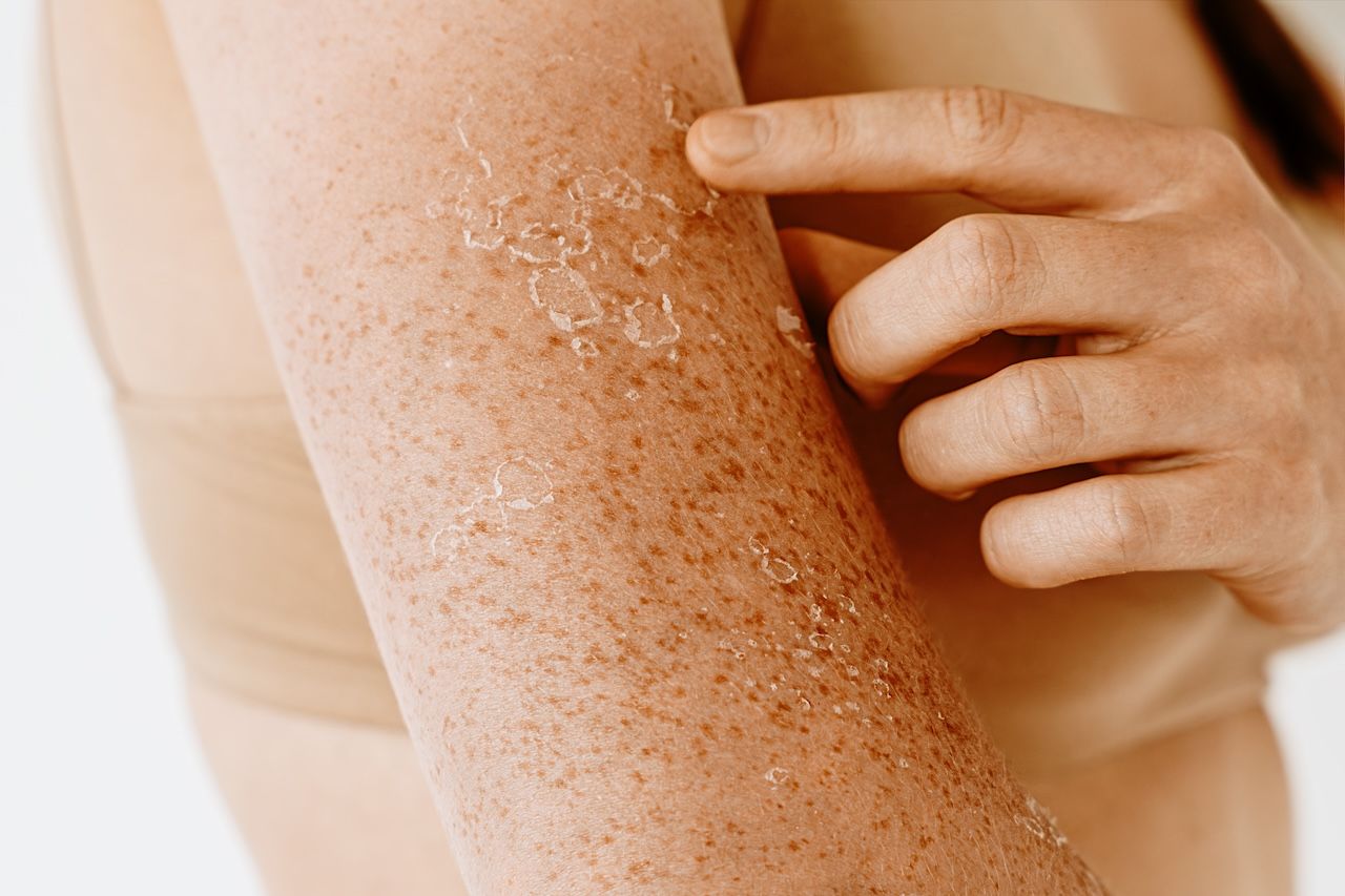 close up of peeling skin showing a compromised skin barrier affecting product absorption
