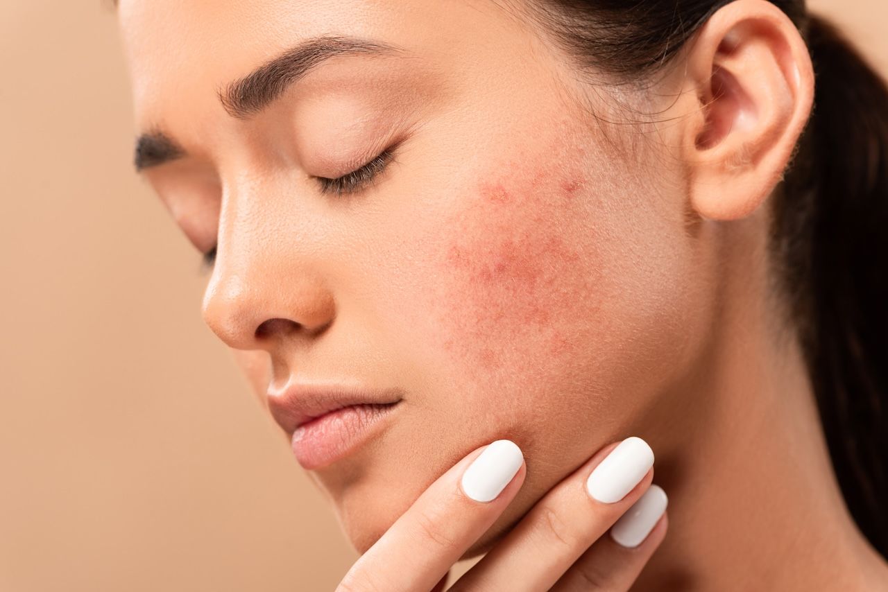infographic for POST-INFLAMMATORY ERYTHEMA AND HOW TO HELP IT FADE