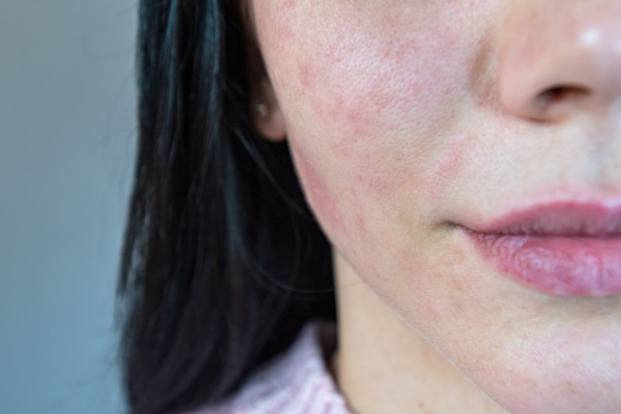 WHAT TRIGGERS ROSACEA AND HOW TO KEEP IT CALM