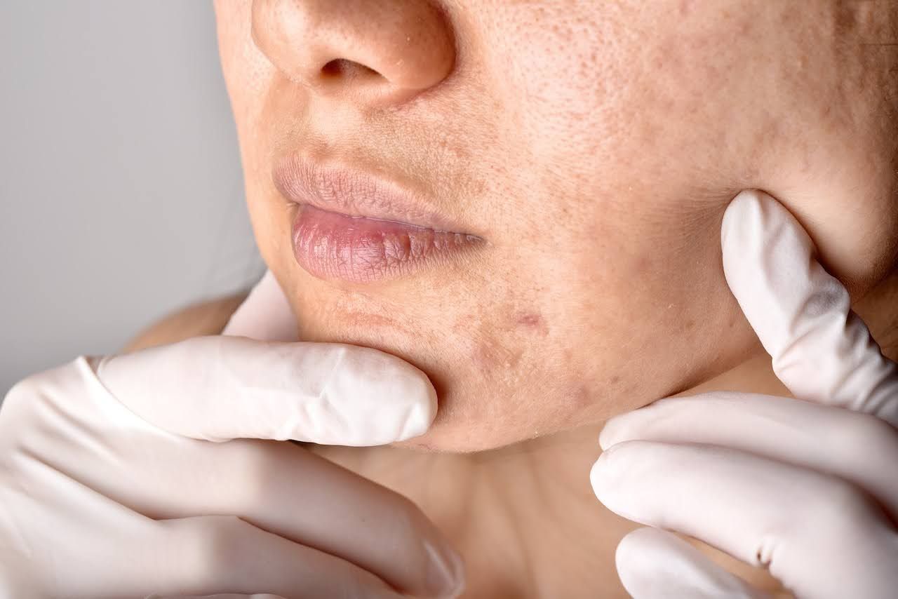woman using vitamin e skincare to improve scars